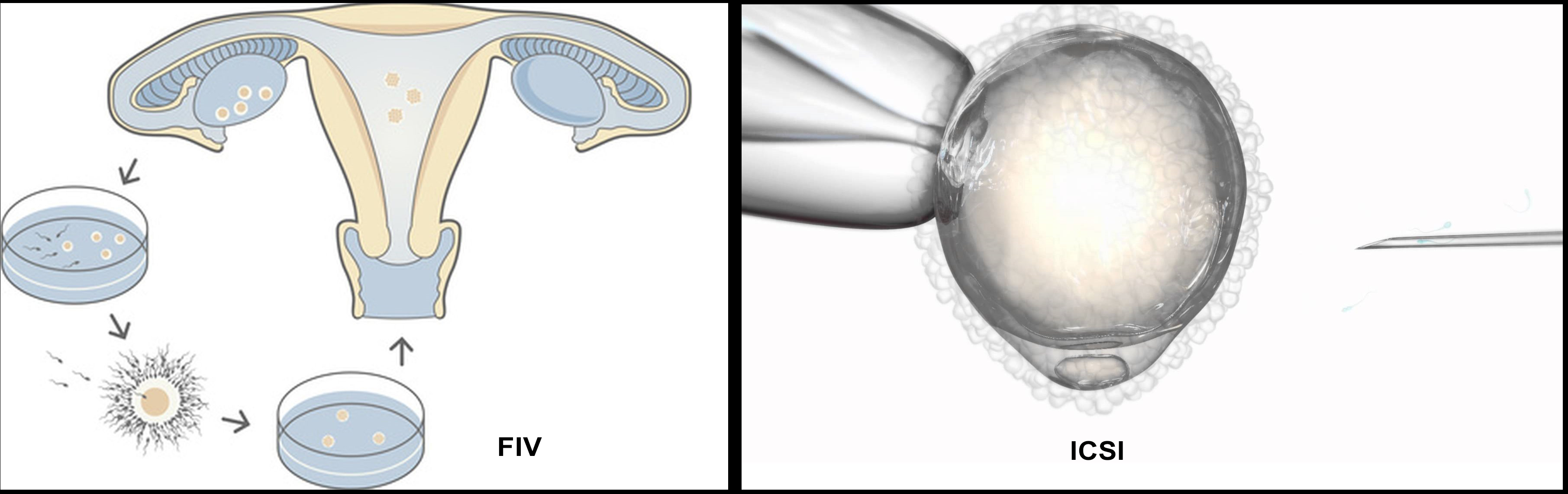 In-vitro fertilization (IVF) process, egg cells being fertilised by sperm outside of the womb